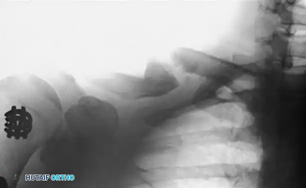 PELVIS AND ACETABULUM Surgical Diagram