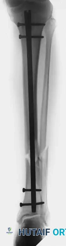 Tibial Nonunion Management: Bone Marrow Injection and Fixation