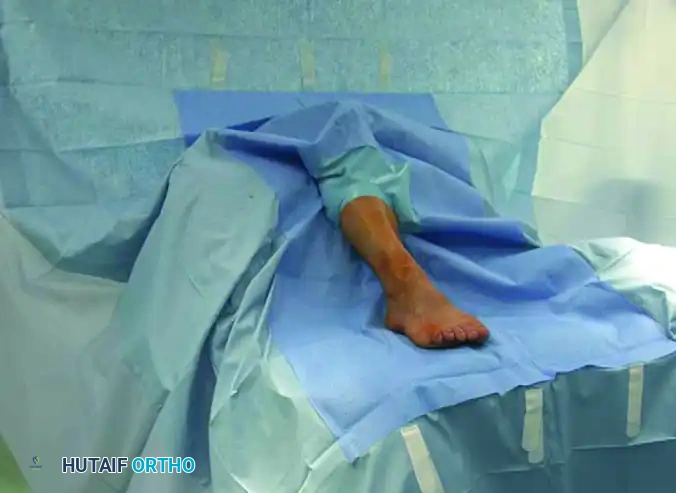 دليلك الشامل لعملية إبهام القدم الأروح بالتدخل المحدود