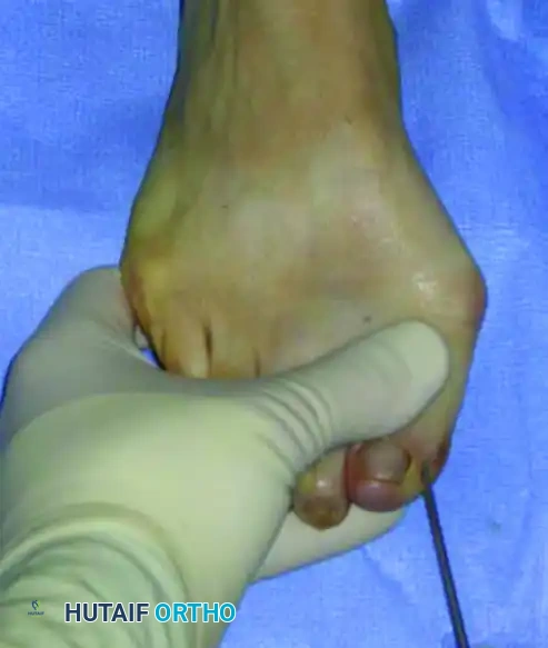 إدخال السلك المعدني الدقيق