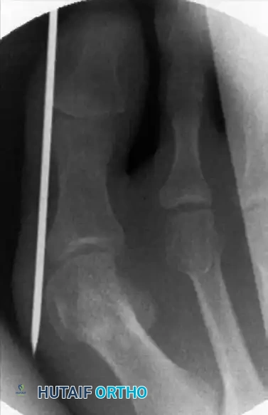 استخدام الأشعة السينية لتحديد موقع القص