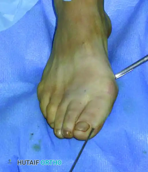 إدخال الأداة الجراحية لتوجيه العظم