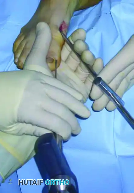 تثبيت العظم في الوضع الصحيح الجديد