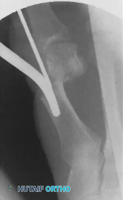 التأكيد النهائي لشكل القدم بالأشعة