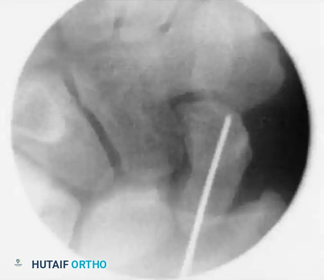 Guidewire Insertion A
