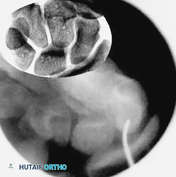 Guidewire Insertion B