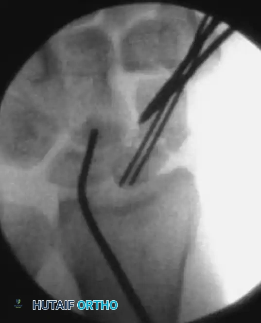 Measuring Scaphoid Length