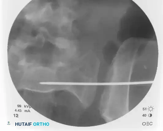 Percutaneous Iliosacral Screw Fixation: A Comprehensive Surgical Masterclass