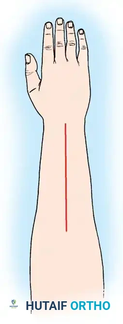 Radial Nerve Palsy: Advanced Surgical Principles and Tendon Transfers