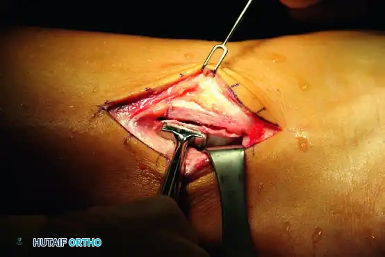 PERONEAL TENDON REPAIR-RECONSTRUCTION Surgical Diagram