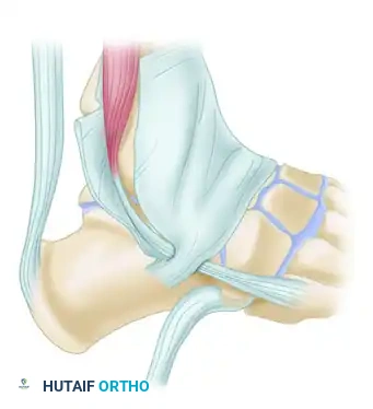 FIGURE 82-60 Plantar surface of foot. 1, Peroneus brevis tendon; 2, reflected peroneus longus tendon with sesamoid; 3, inferior peroneal retinaculum with dividing septum; 4, deep surface of superior peroneal retinaculum; 5, sulcus of fibula for peroneal tendons.