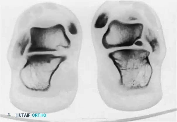 PERONEAL TENDON SUBLUXATION AND DISLOCATION Surgical Diagram