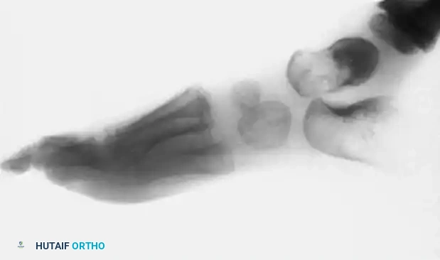 Mastering Peroneal Tendon Subluxation and Occult Hindfoot Derangements