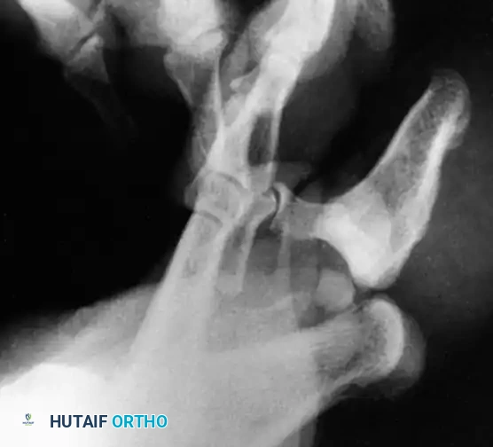 Fig. 86-50 Anteroposterior radiograph shows overlapping of proximal phalangeal head and distal phalangeal base. (From Miki T, Yamamuro T, Kitai T: An irreducible dislocation of the great toe: report of two cases and review of the literature, Clin Orthop Relat Res 230:200, 1988.)