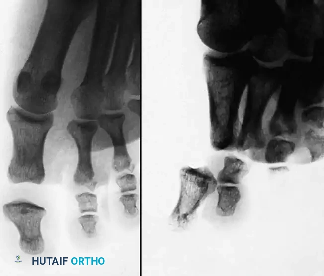 Phalangeal & MTP Joint Dislocations: Surgical Management