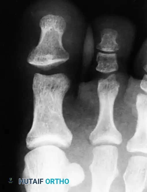 Fig. 86-52 Interphalangeal joint space remains wider than normal after closed reduction; this is an indication for open reduction. (From Miki T, Yamamuro T, Kitai T: An irreducible dislocation of the great toe: report of two cases and review of the literature, Clin Orthop Relat Res 230:200, 1988.)