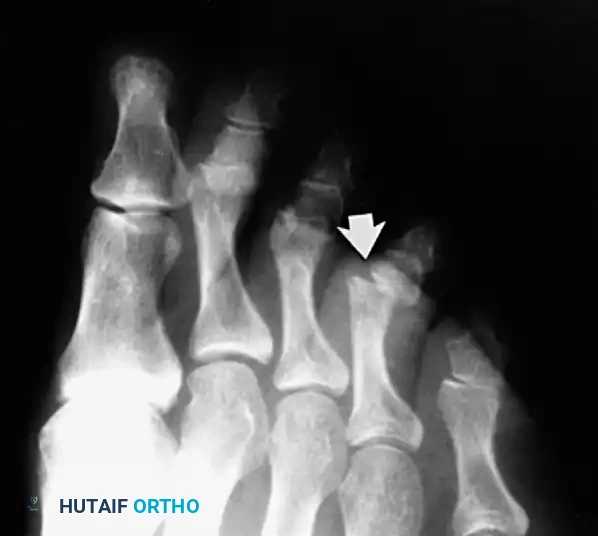 Fig. 86-51 Recurrent dislocation of proximal interphalangeal joint of right fourth toe was treated successfully by resection of head and neck of proximal phalanx and immobilization for 3 weeks.