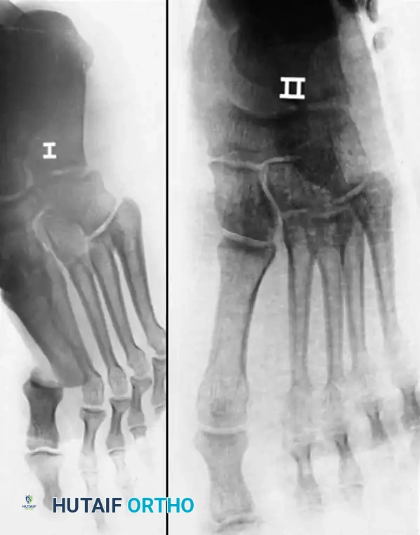 Fig. 86-53 Dorsomedial dislocation of fi rst metatarsophalangeal joint. A, Dislocation could not be reduced by closed means. B, After open reduction, joint was stable.