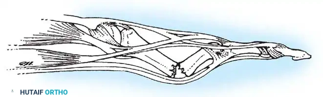 Operative Management of Phalangeal Fractures and PIP Joint Fracture-Dislocations