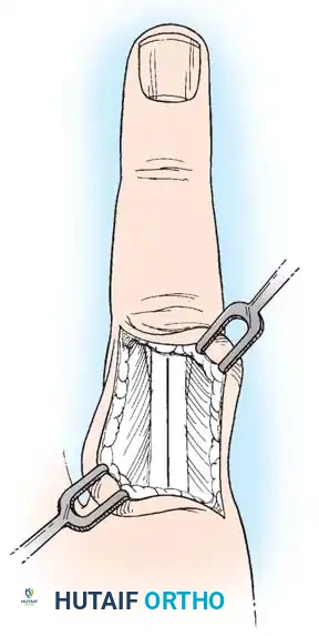 Extensor mechanism