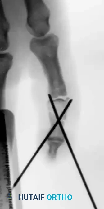 Fig. 64-48 A, Crush injury to small fi nger resulting in middle phalangeal fracture. B and C, Fracture was inherently unstable and required stabilization. D and E, Pratt technique of crossed Kirschner wire fi xation provided good alignment and stability.