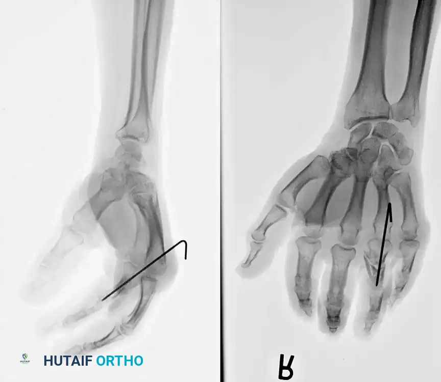 Fig. 64-49 Belsky-Eaton pinning. A, Markedly unstable proximal phalangeal fracture treated by percutaneous pinning (B) across metacarpophalangeal joint. Metacarpophalangeal joint should be fl exed at least 60 to 70 degrees, and proximal interphalangeal joint is not crossed.