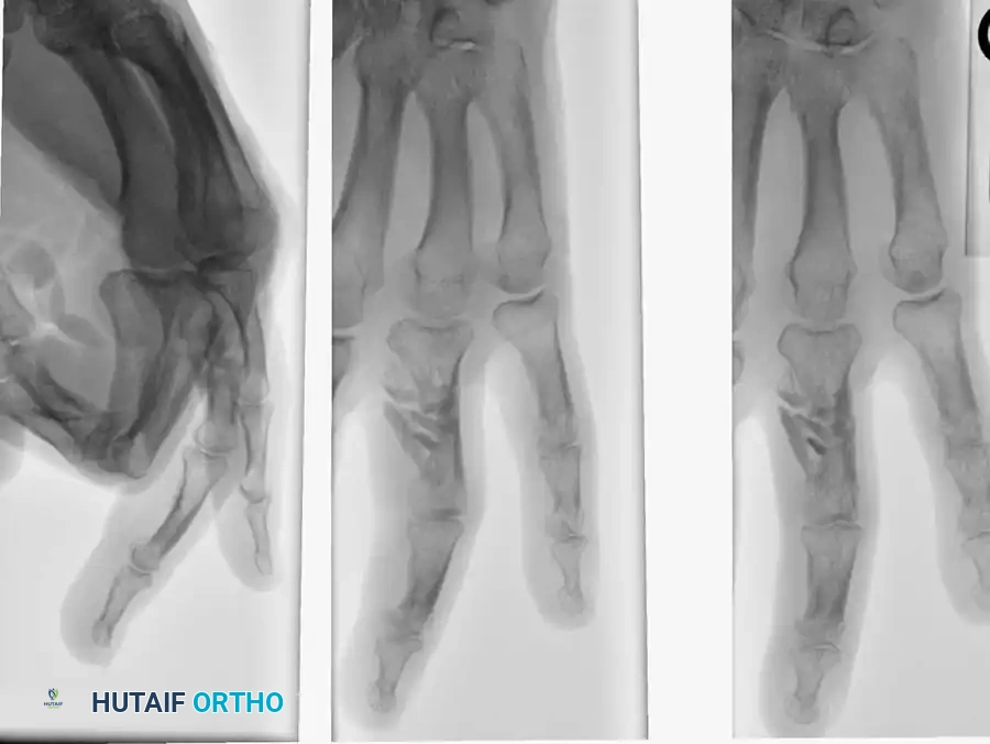 PHALANGES Surgical Diagram