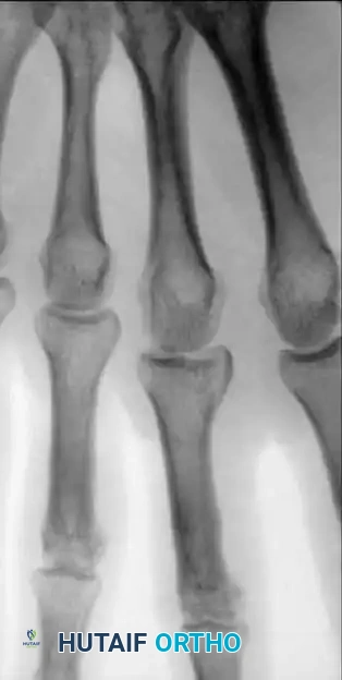 Fig. 64-50 A and B, Comminuted intraarticular fracture in middle fi nger proximal phalanx base of avid tennis player treated by screw fi xation.