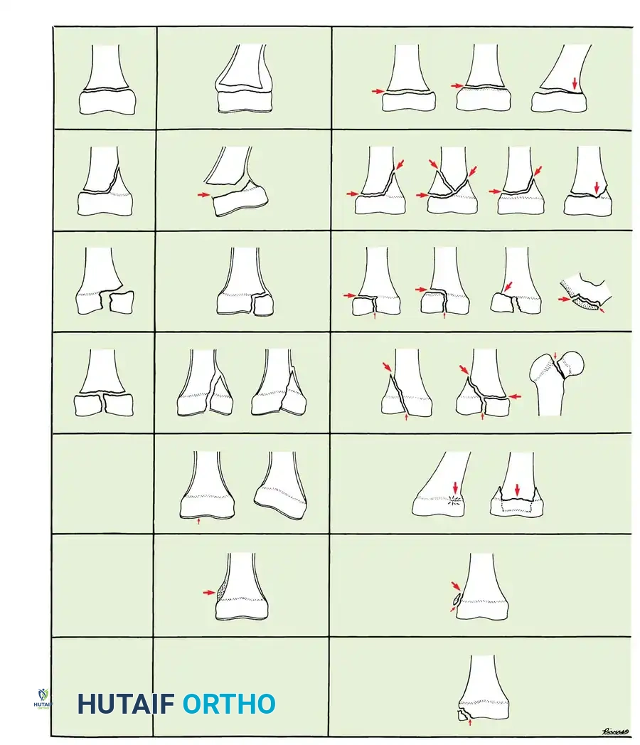 Comprehensive Guide to Physeal Injuries: Classification & Surgery