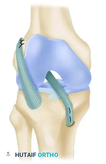 FIGURE 51-44 Technique of physeal-sparing, combined intraar ticular and extraarticular reconstruction of anterior cruciate liga ment. (Redrawn from Kocher MS, Garg S, Micheli LJ: Physeal sparing reconstruction of the anterior cruciate ligament in skeletally immature prepubescent children and adolescents, J Bone Joint Surg 87A:2371, 2005.) SEE TECHNIQUE 51-21.