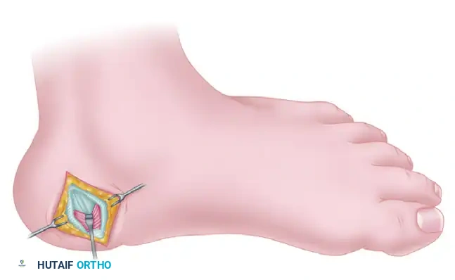 Superficial fascia of abductor hallucis muscle is released