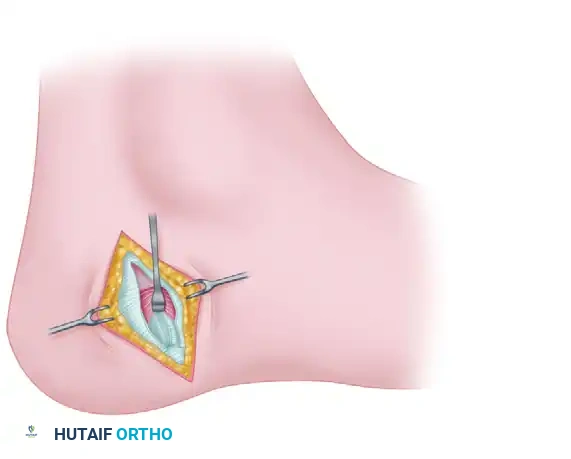 Incision over first branch of lateral plantar nerve