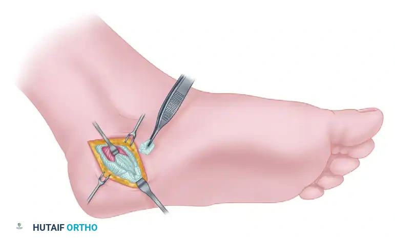 Resection of small medial portion of plantar fascia