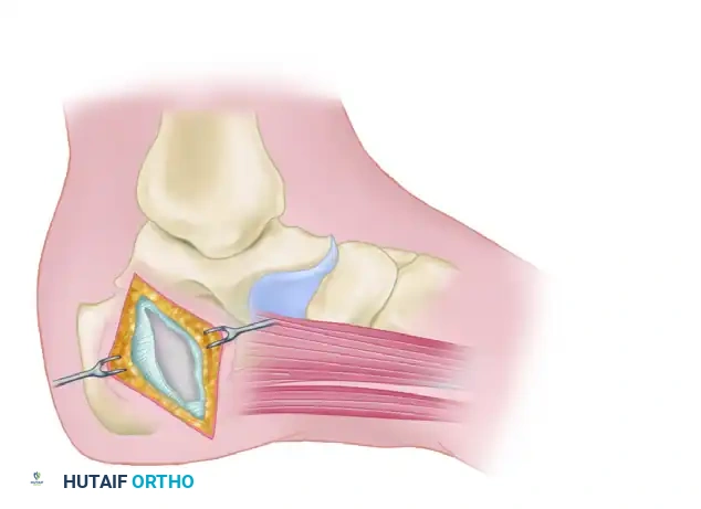 Abductor hallucis muscle is retracted distally