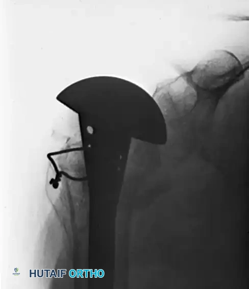 Preoperative Radiograph of Proximal Humerus Fracture-Dislocation