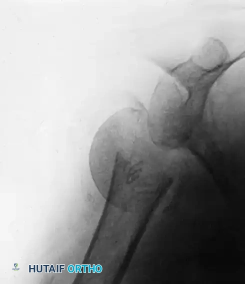 Postoperative Radiograph of Neer I Prosthesis