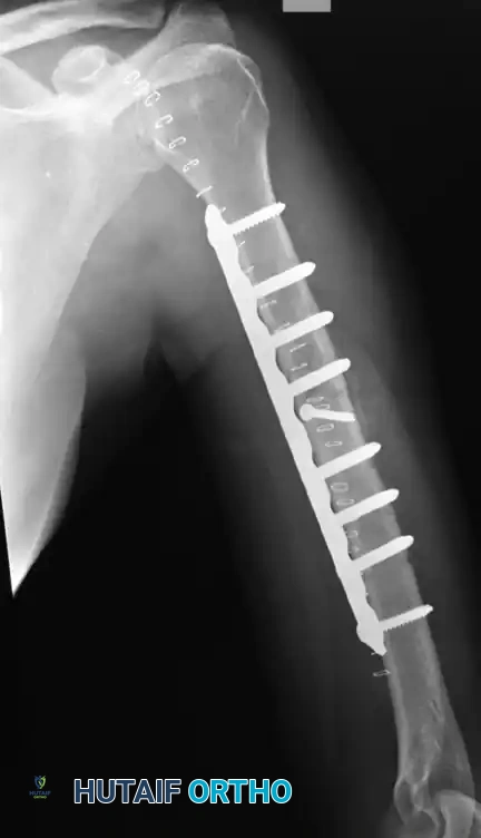 FIGURE 57-36 Dual plating of distal metaphyseal-diaphyseal humeral shaft fracture.