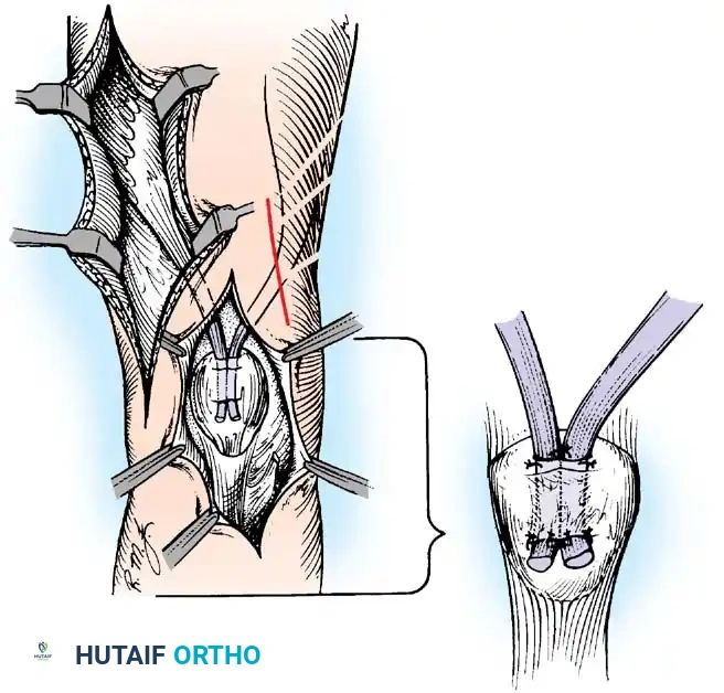 Operative Management of Poliomyelitis: Orthopaedic Principles