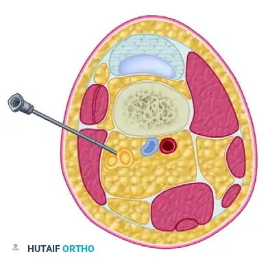 Popliteal Sciatic Nerve Block: Comprehensive Surgical Technique