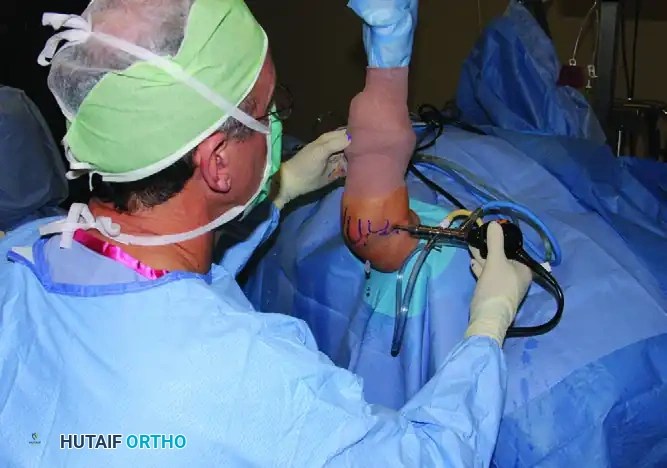 PORTAL PLACEMENT Surgical Diagram