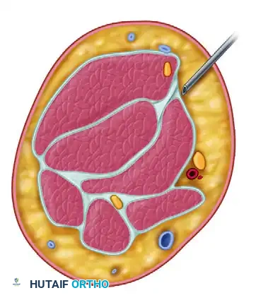 PORTAL PLACEMENT Surgical Diagram