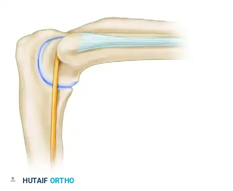 PORTAL PLACEMENT Surgical Diagram
