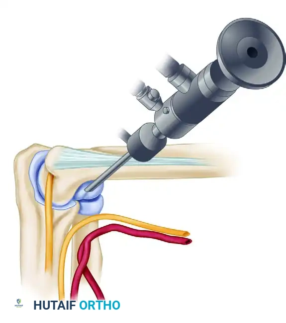 PORTAL PLACEMENT Surgical Diagram