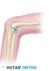 PORTAL PLACEMENT Surgical Diagram