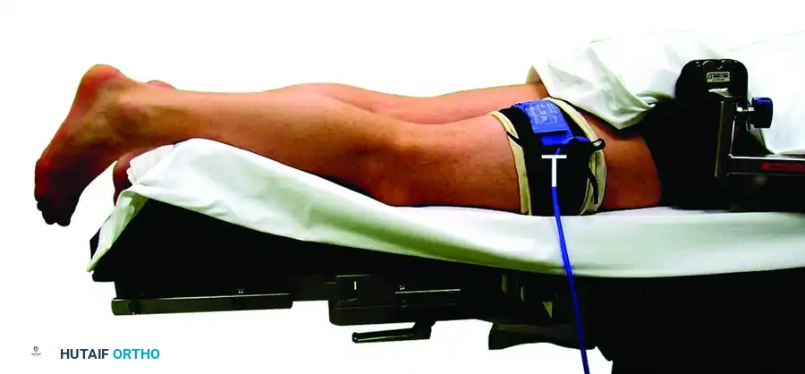 POSTERIOR DÉBRIDEMENT FOR ANKLE IMPINGEMENT Surgical Diagram