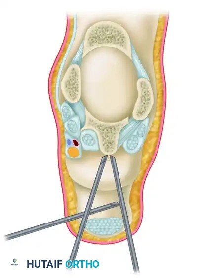 POSTERIOR DÉBRIDEMENT FOR ANKLE IMPINGEMENT Surgical Diagram