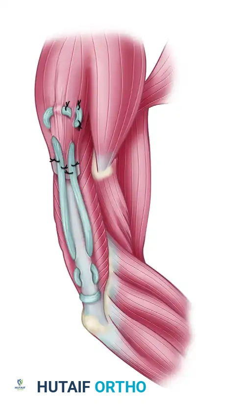 POSTERIOR DELTOID-TO-TRICEPS TRANSFER Surgical Diagram