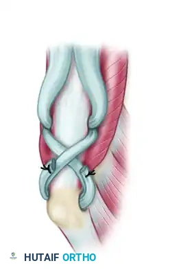 POSTERIOR DELTOID-TO-TRICEPS TRANSFER Surgical Diagram