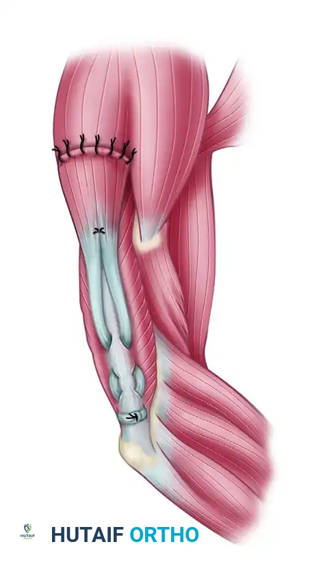 POSTERIOR DELTOID-TO-TRICEPS TRANSFER Surgical Diagram