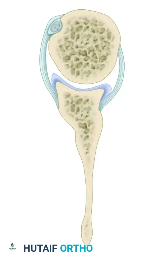 Measurement of version of chondrolabral and osseous portions of the glenoid